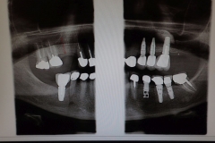 Lantana Florida Periodontal and Dental Implant X-Rays 0002